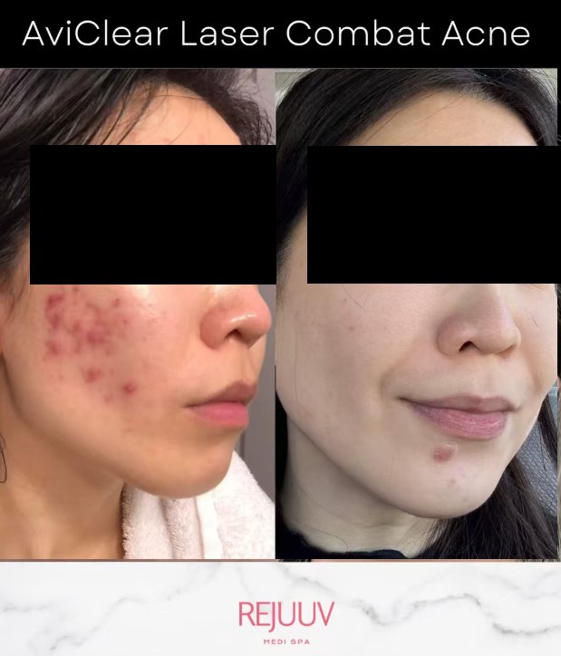 Before and after: Aviclear