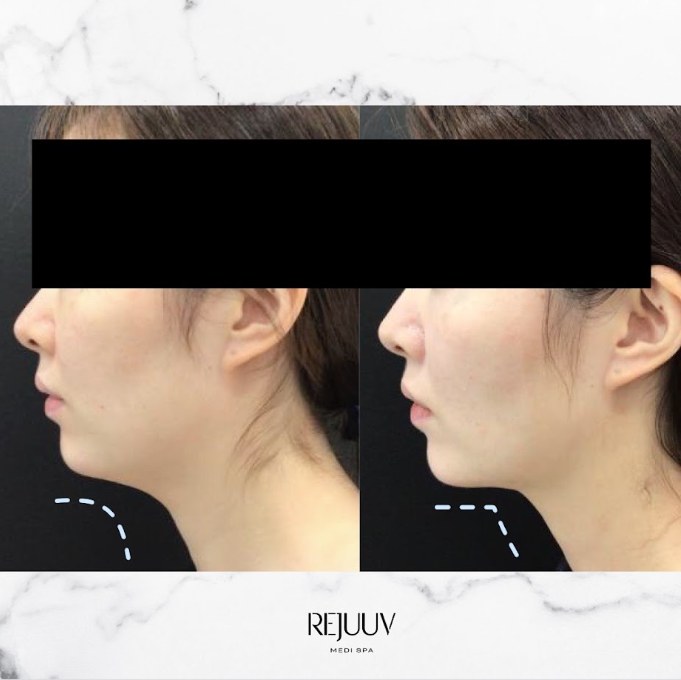 Before and after: Belkyra