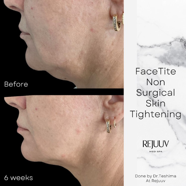 Before and after: BodyTite