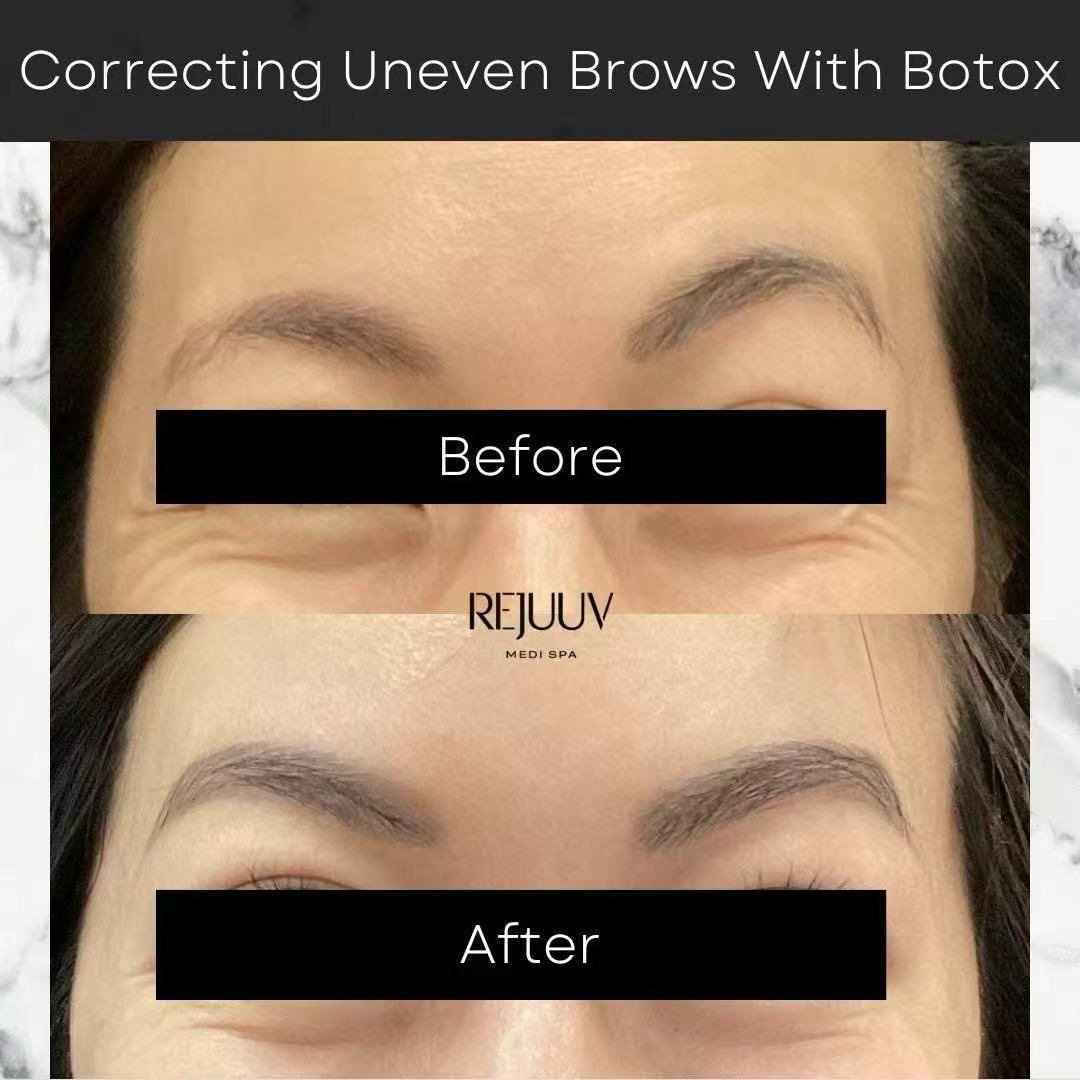 Before and after: Botox