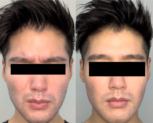 Before and after: Botox