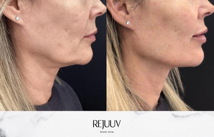 Before and after: Dermal Filler