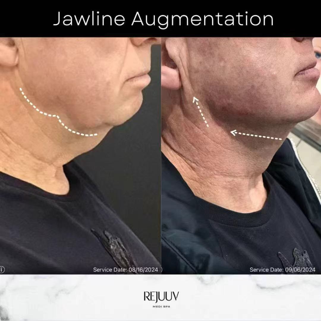 Before and after: Dermal Filler