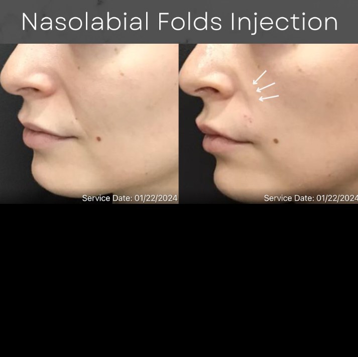 Before and after: Dermal Filler