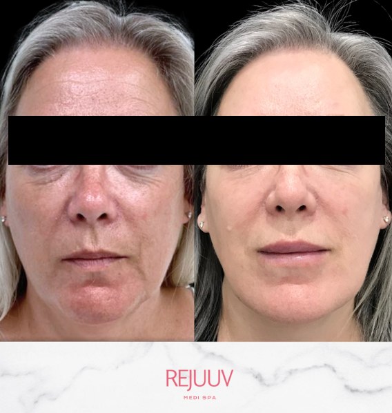 Before and after: Dermal Filler