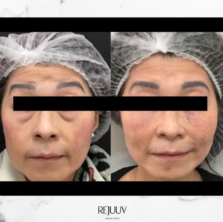 Before and after: Dermal Filler
