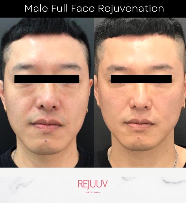 Before and after: Dermal Filler