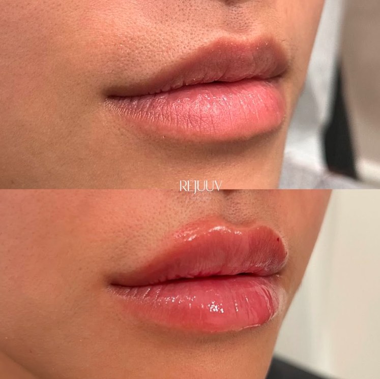 Before and after: Dermal Filler