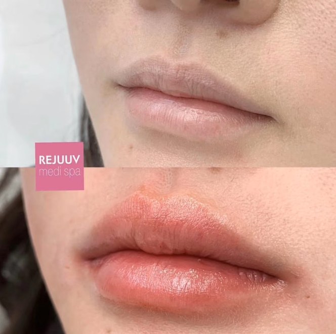 Before and after: Dermal Filler