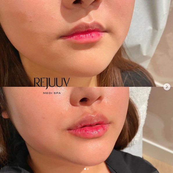 Before and after: Dermal Filler