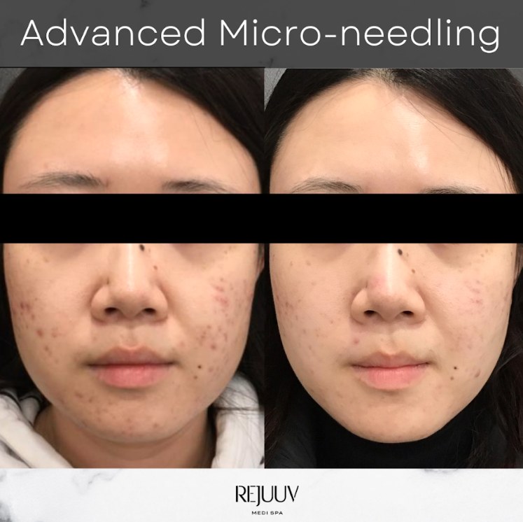 Before and after: DP4 Microneedling
