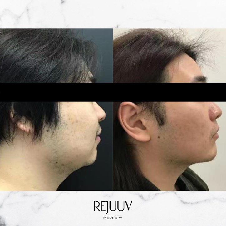 Before and after: Exilis