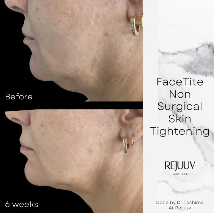 Before and after: Facetite