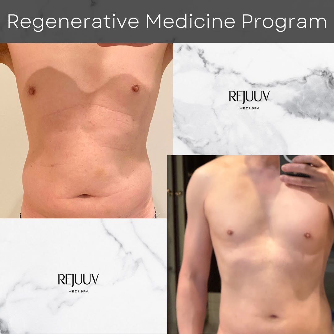 Before and after: Hormones Replacement Therapy