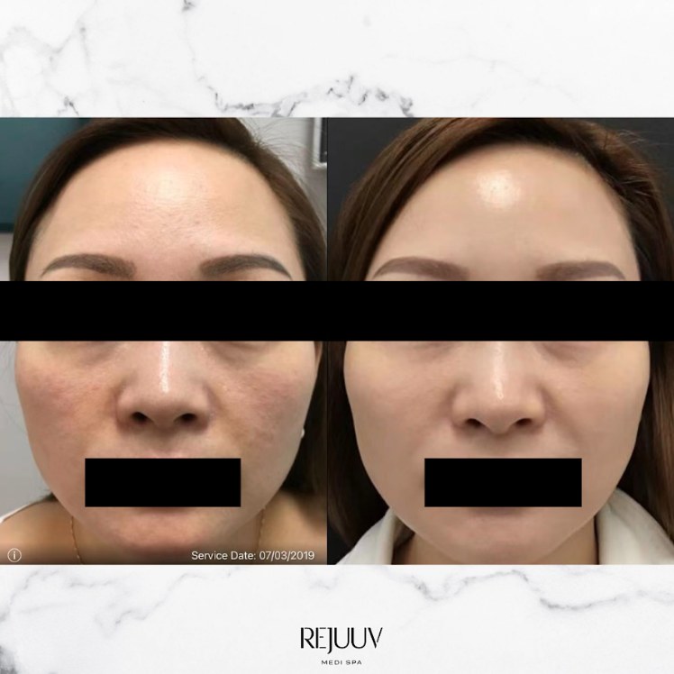 Before and after: Mesotherapy