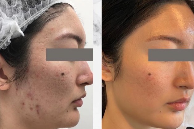 Before and after: Morpheus 8