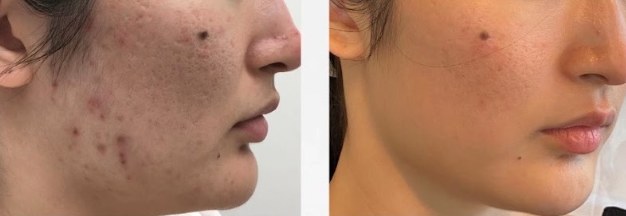 Before and after: Morpheus 8
