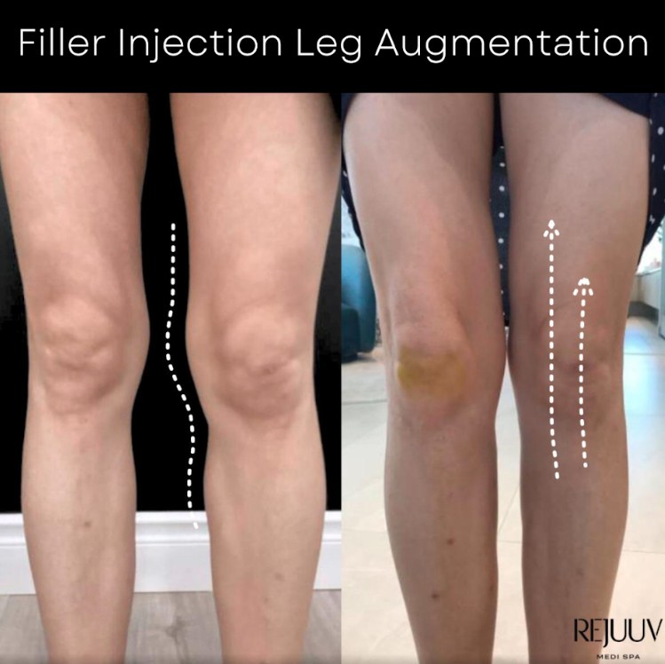 Before and after: Non-surgical Body Enhancement