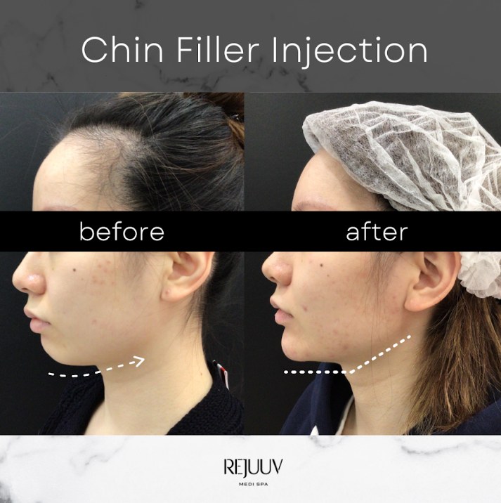 Before and after: Non-surgical Jawline Enhancement