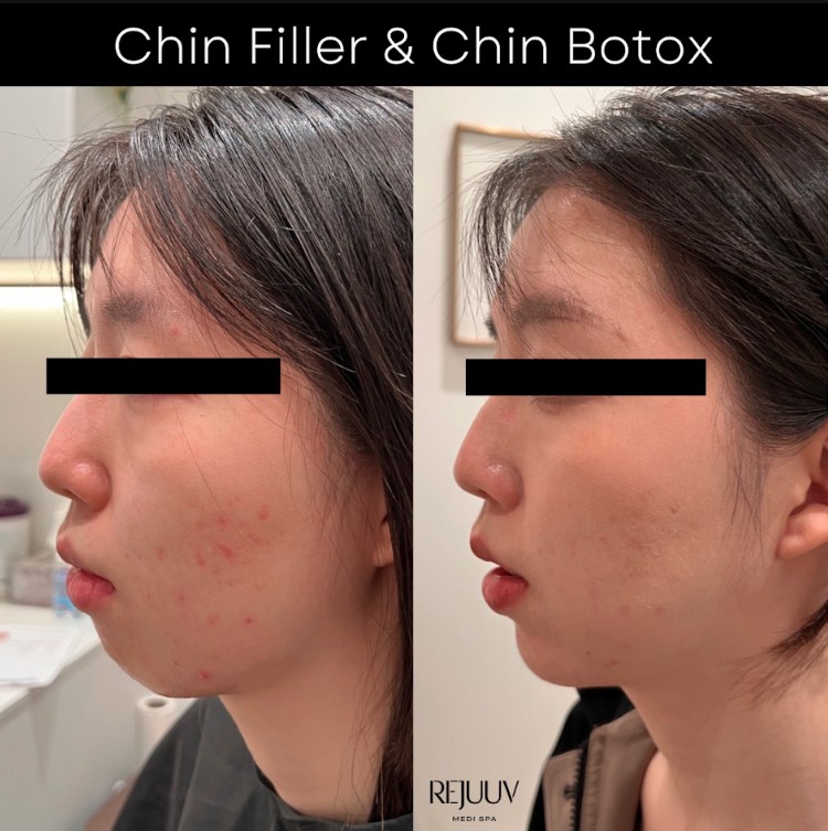 Before and after: Non-surgical Jawline Enhancement