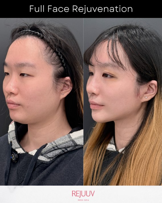 Before and after: Non-surgical Jawline Enhancement