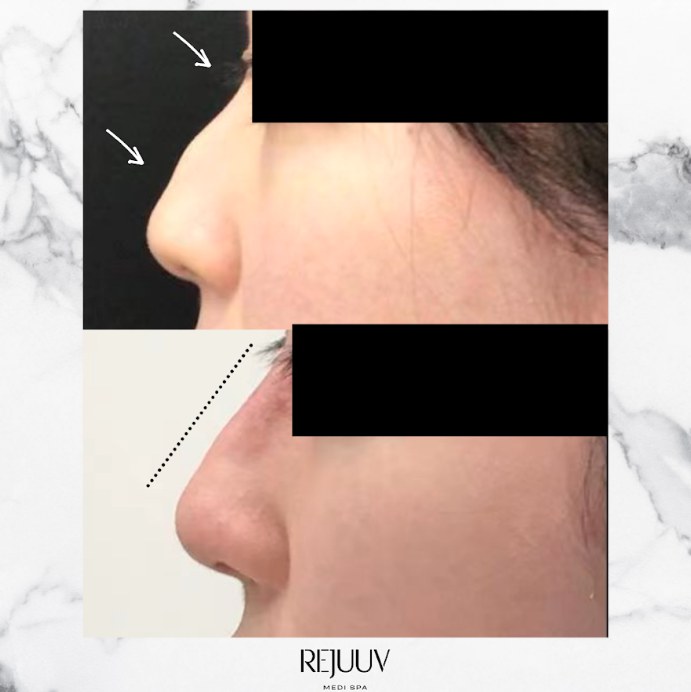 Before and after: Non-surgical Rhinoplasty