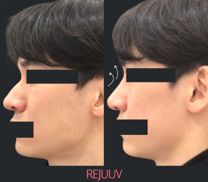 Before and after: Non-surgical Rhinoplasty