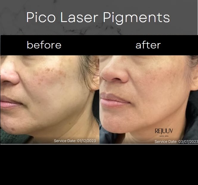 Before and after: PicoSure