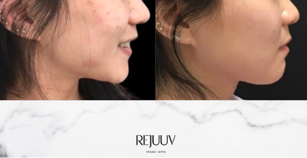 Before and after: PicoSure