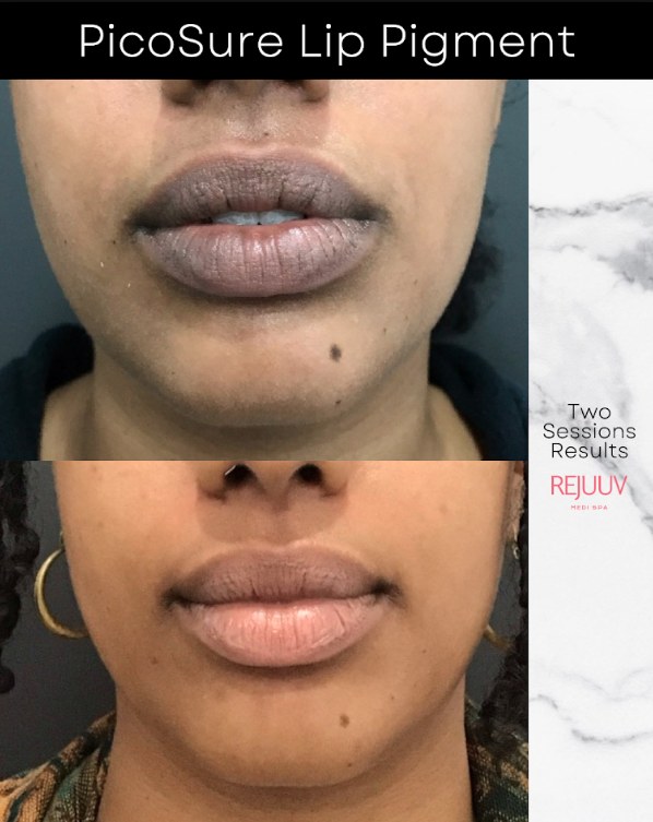 Before and after: PicoSure