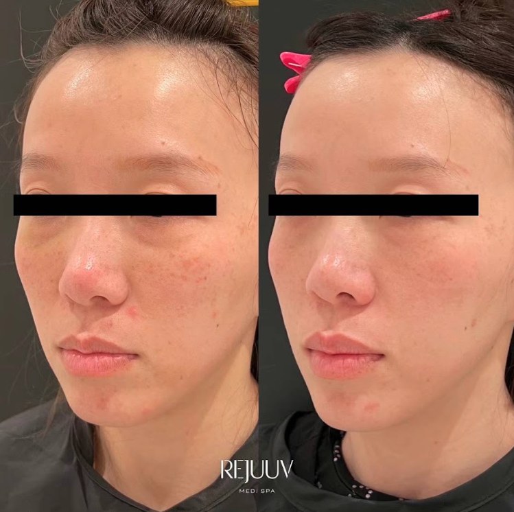 Before and after: PicoWay