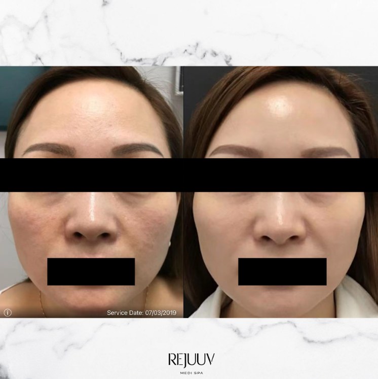 Before and after: PRP