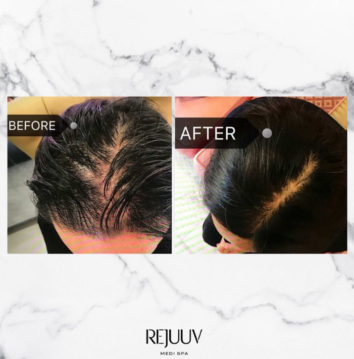 Before and after: Hair Restoration