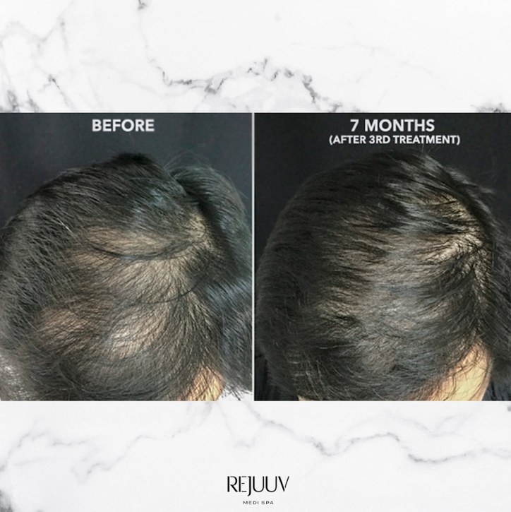 Before and after: Hair Restoration