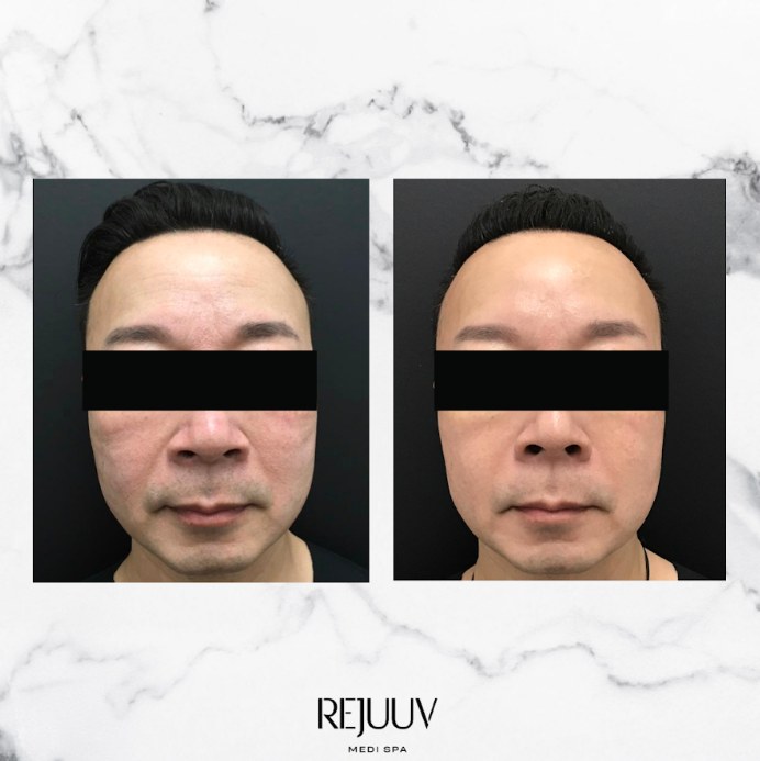 Before and after: Sculptra
