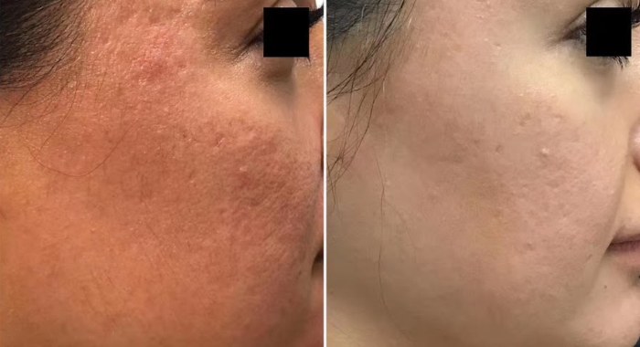 Before and after: Subcision