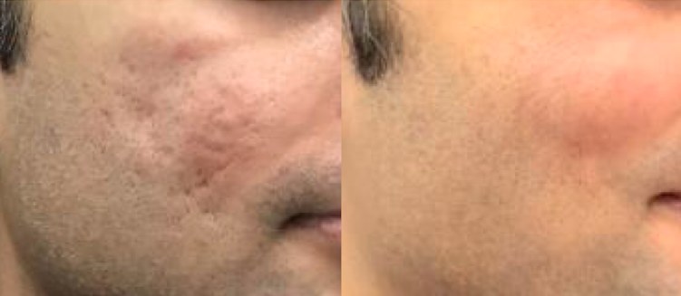 Before and after: Subcision