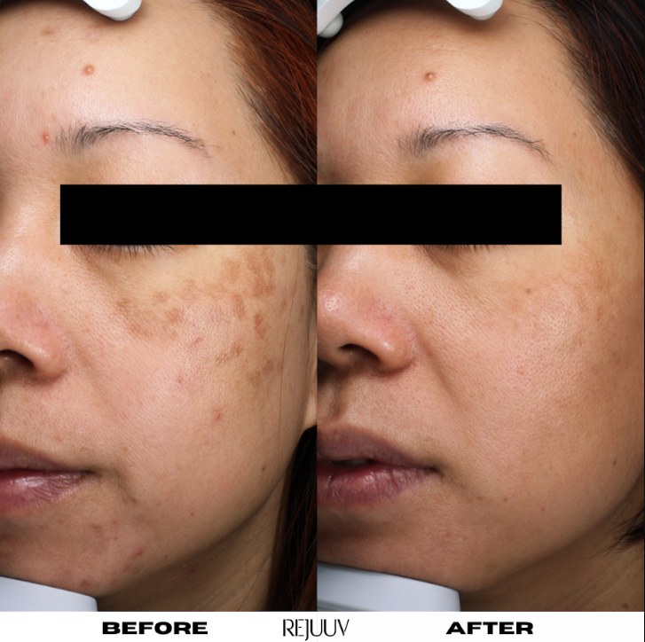 Before and after: Sylfirm X
