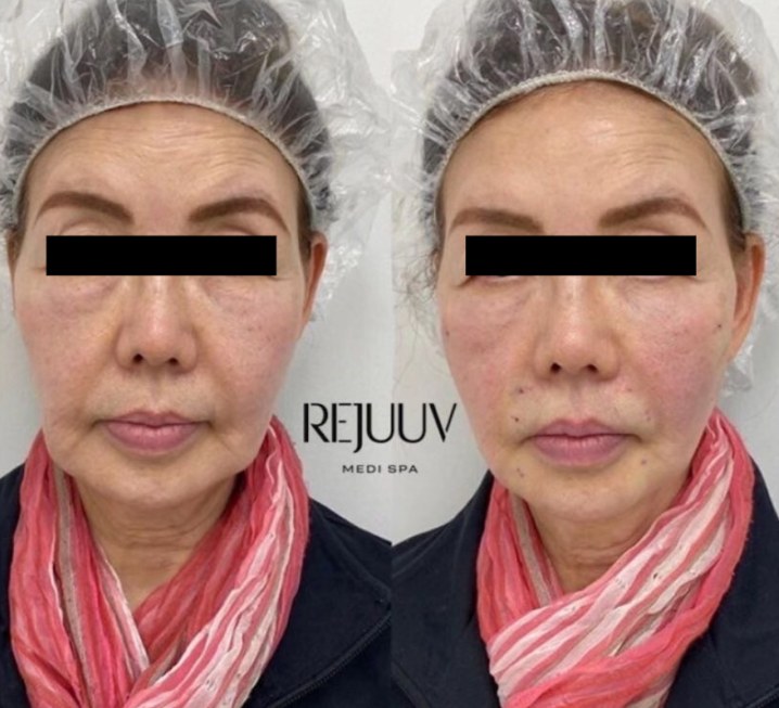 Before and after: Thread Lift