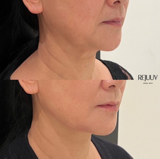 Before and after: Ultherapy