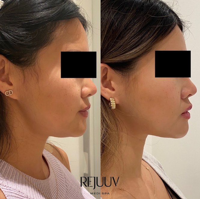 Before and after: Ultherapy
