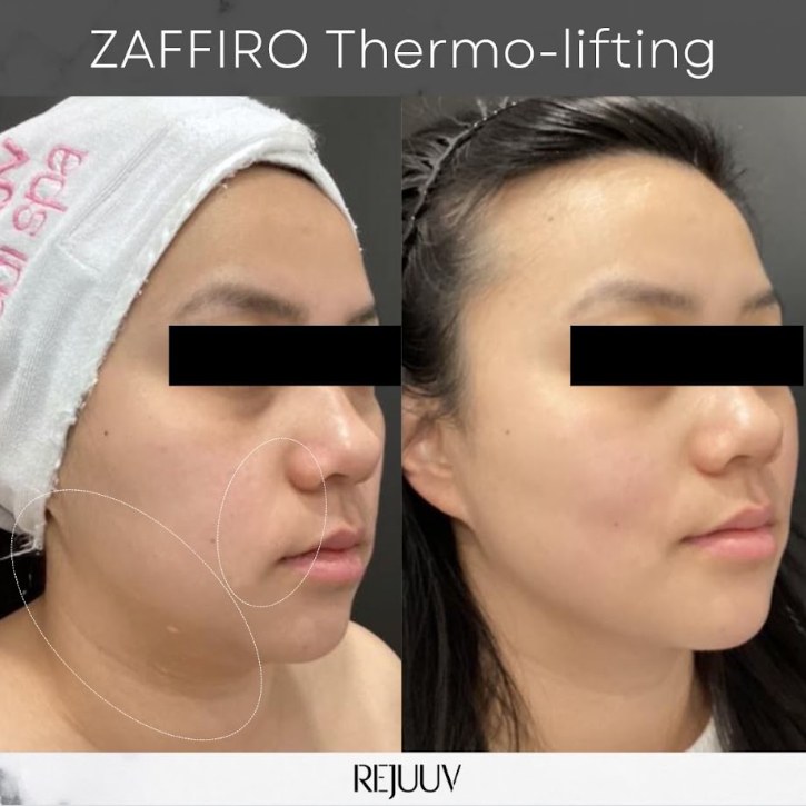 Before and after: Zaffiro
