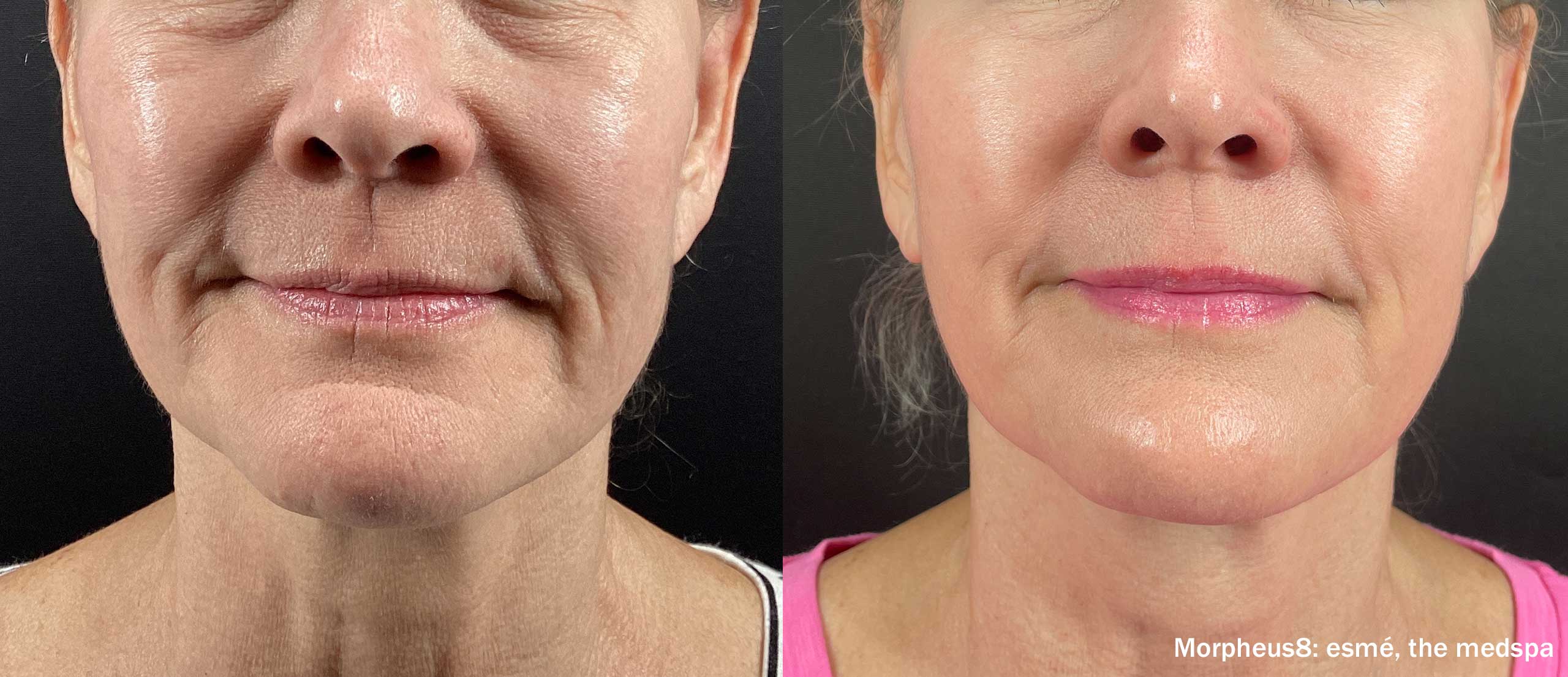 Before and after a course of Morpheus8 treatments on the lower face and neck