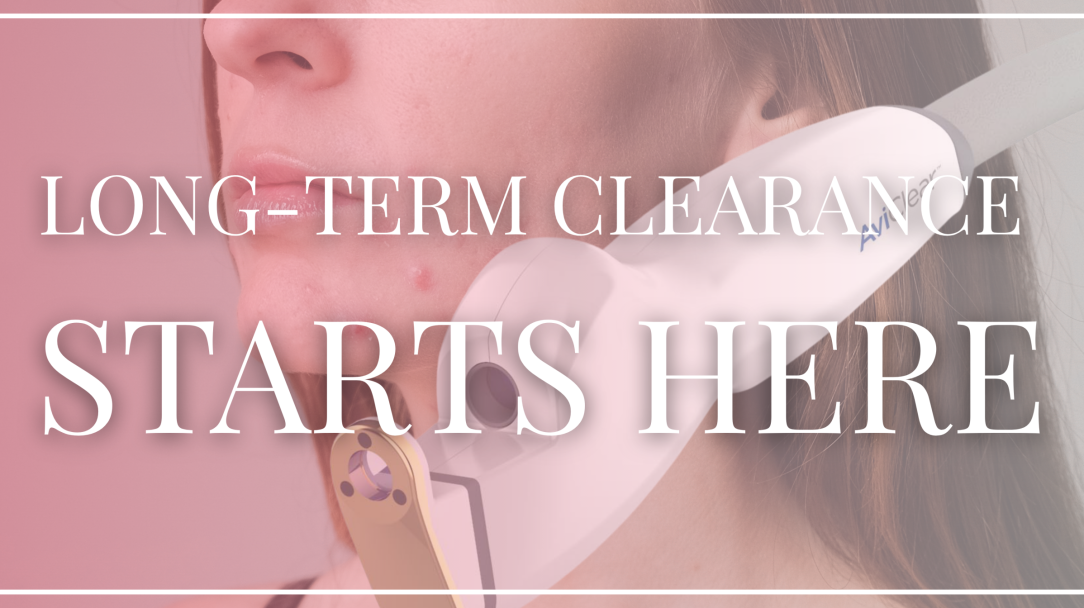 How AviClear Laser Treatment Provides Long-Term Acne Clearance​​​