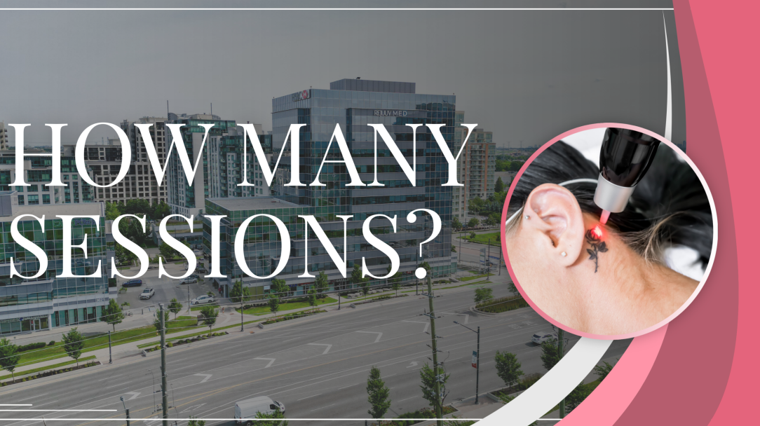How Many PicoSure Tattoo Removal Sessions Do You Need_ What to Expect in Markham, Toronto & North York